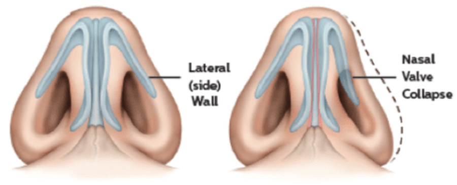 Nasal Valve Collapse illustration